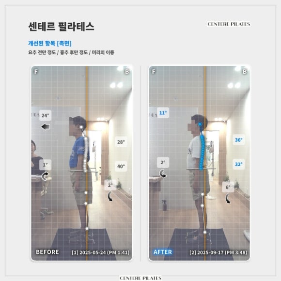 거북목 왜 방치하세요?